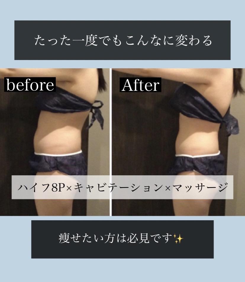 初回ハイフ〜8P症例〜