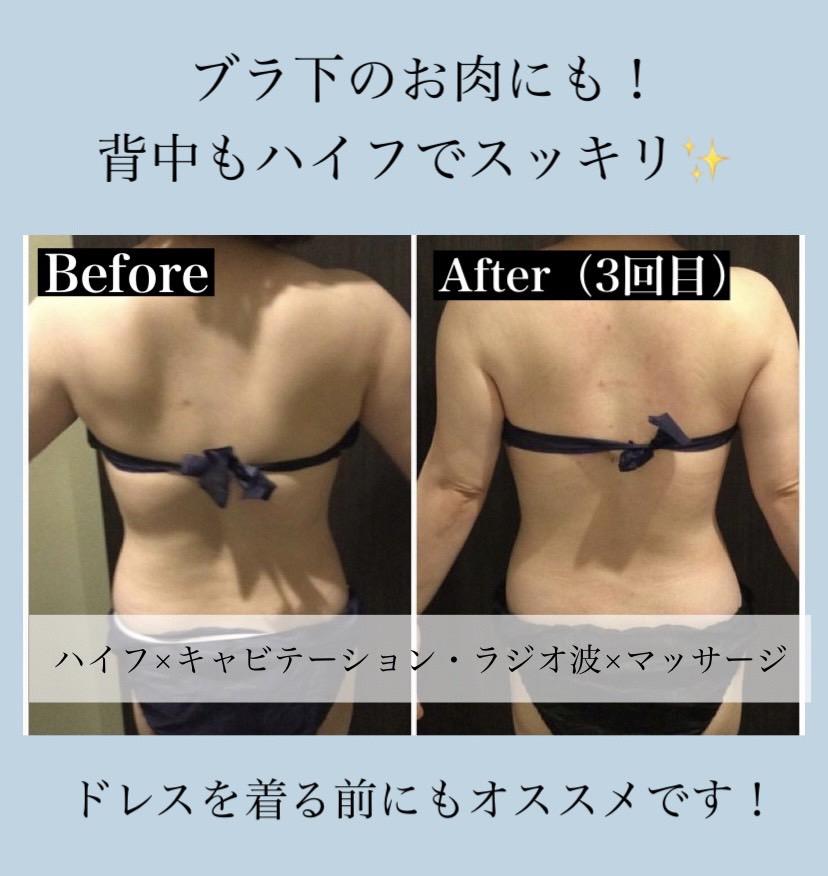ブラ下もスッキリ！背中ハイフ