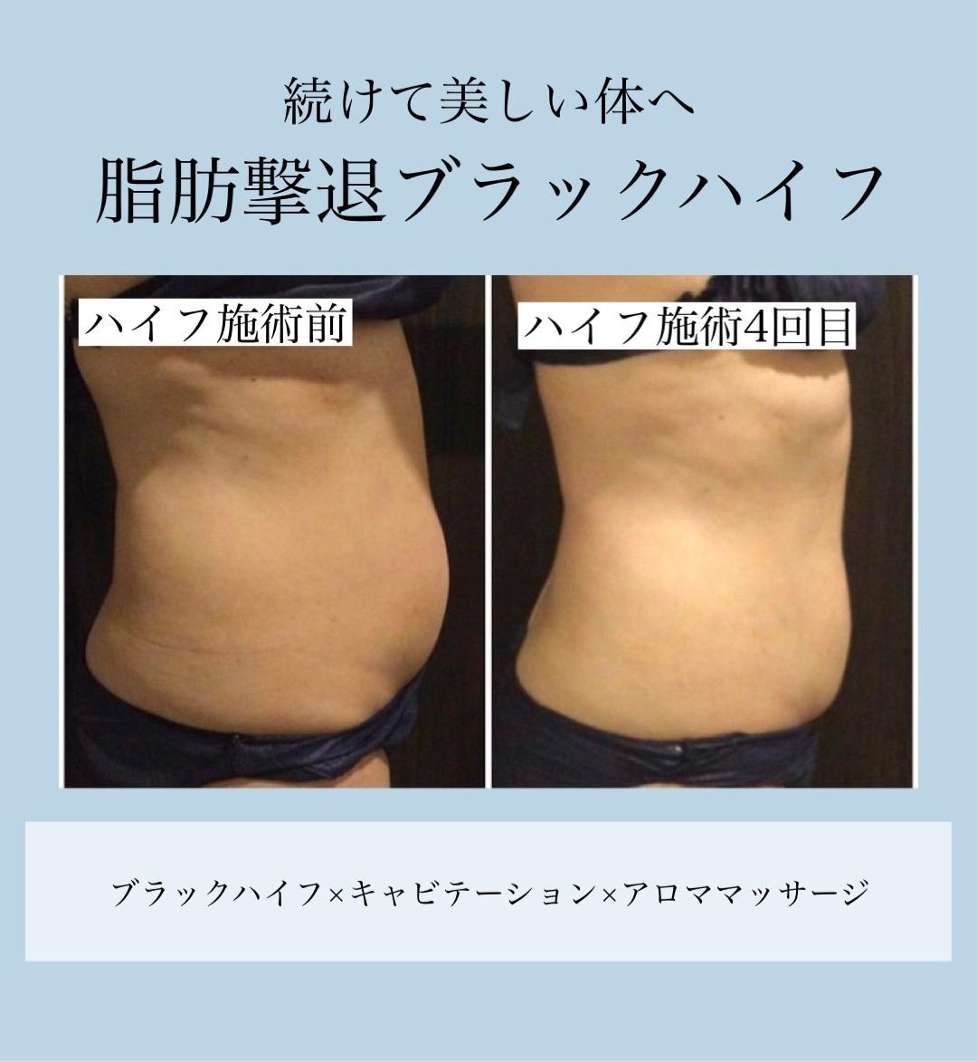気になる部分の脂肪スッキリ♪