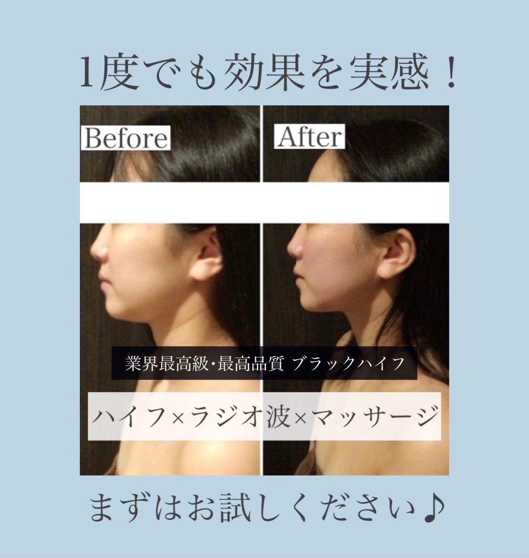 一度でも効果を実感！Re,Luxのフェイシャルハイフ